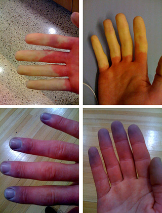 Illustration for article titled The phenomenon that makes hands change color